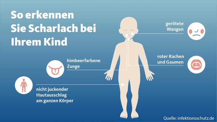 Die Symptome: Gerötete Wangen, himbeerfarbene Zunge, roter Rachen und Gaumen, nicht juckender Hautausschlag am ganzen Körper