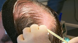 Das Bild zeigt eine Haartransplantation bei einem Mann.